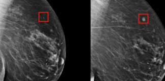 Inteligência artificial jé é capaz de prever câncer de mama cinco anos antes de apresentar sintomas