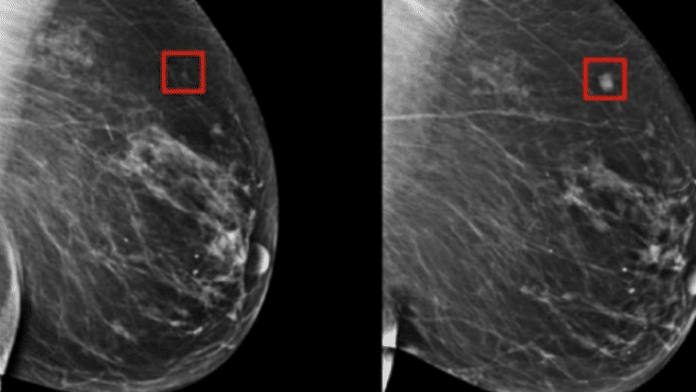 Inteligência artificial jé é capaz de prever câncer de mama cinco anos antes de apresentar sintomas