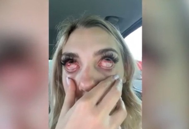 psicologiasdobrasil.com.br - Adolescente fica com 'olhos de zumbi' após extensões de cílios: 'Achei que ficaria cega'