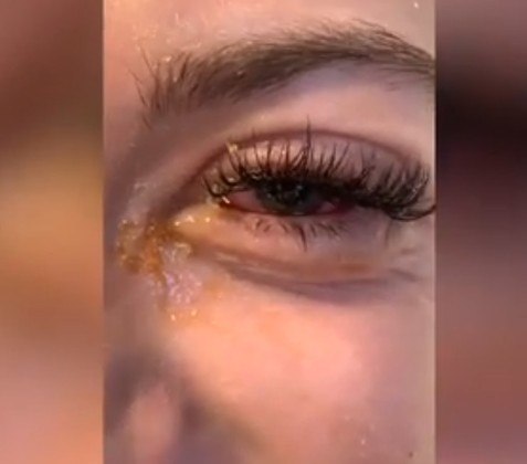 psicologiasdobrasil.com.br - Adolescente fica com 'olhos de zumbi' após extensões de cílios: 'Achei que ficaria cega'