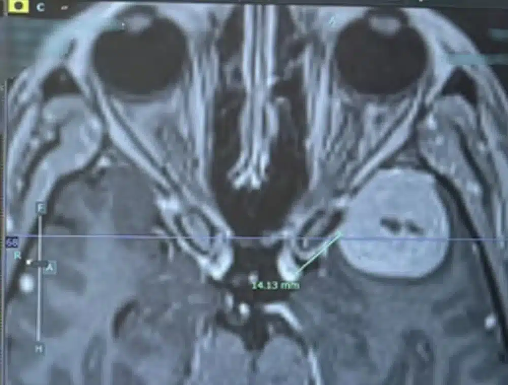 psicologiasdobrasil.com.br - Mulher descobre tumor cerebral após achar que colegas de trabalho estavam "falando em outro idioma"