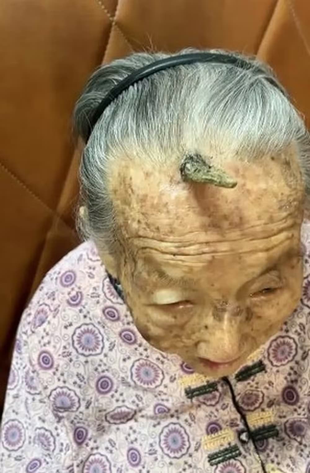 psicologiasdobrasil.com.br - Entenda a condição que fez 'chifre' crescer em idosa de 107 anos na China