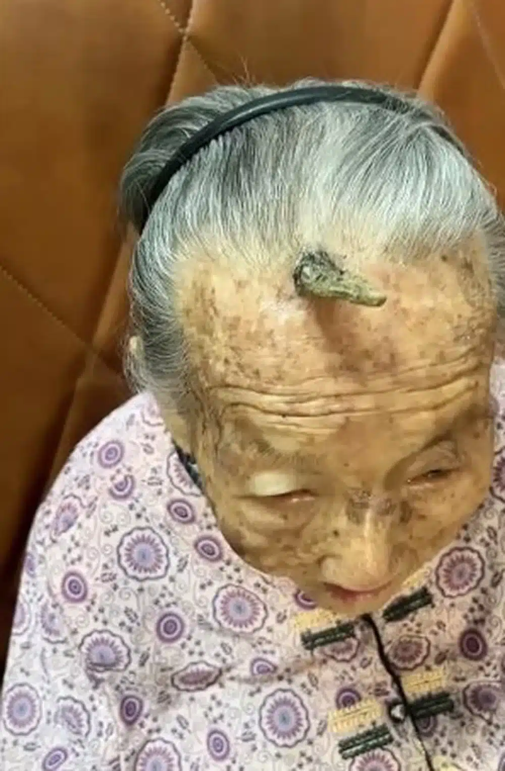 psicologiasdobrasil.com.br - Entenda a condição que fez 'chifre' crescer em idosa de 107 anos na China