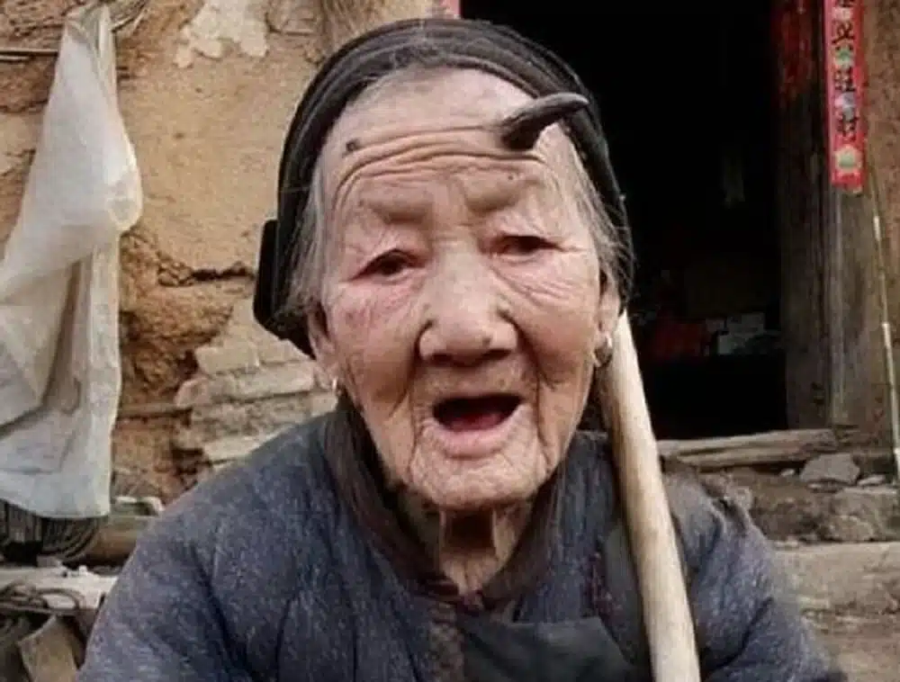 psicologiasdobrasil.com.br - Entenda a condição que fez 'chifre' crescer em idosa de 107 anos na China