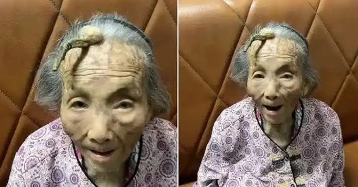 Entenda a condição que fez ‘chifre’ crescer em idosa de 107 anos na China