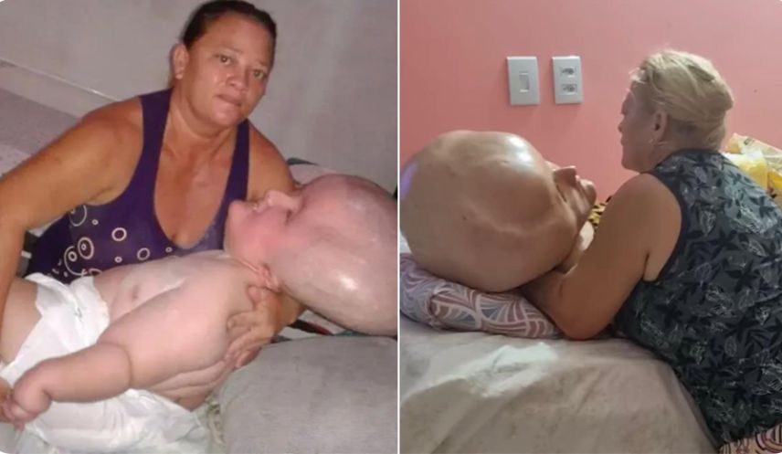 psicologiasdobrasil.com.br - Mãe de mulher com hidrocefalia gigante exibe sua rotina com a filha e vive de doações