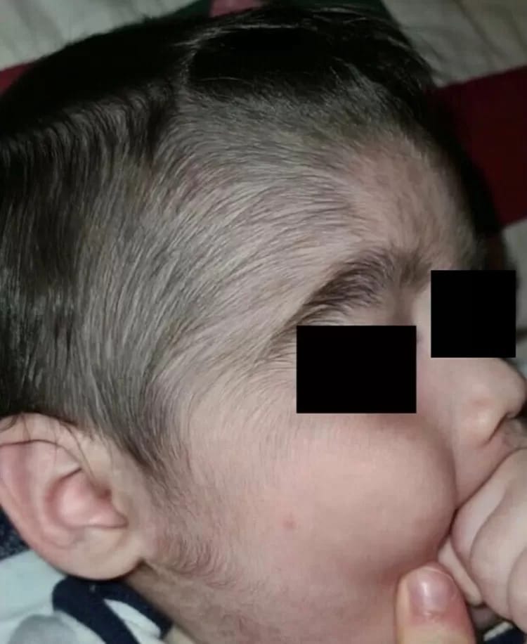 psicologiasdobrasil.com.br - Minoxidil: Loção para calvície usada por pais faz crescer pelos em bebês