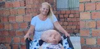 Mãe de mulher com hidrocefalia gigante exibe sua rotina com a filha e vive de doações