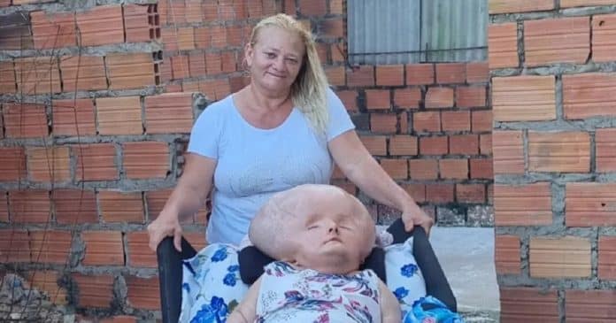 Mãe de mulher com hidrocefalia gigante exibe sua rotina com a filha e vive de doações