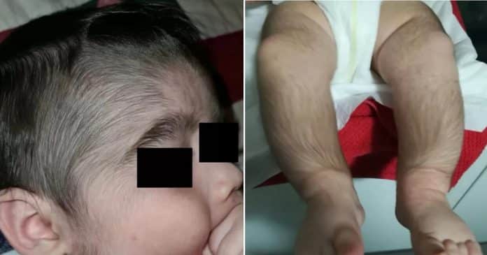 Minoxidil: Loção para calvície usada por pais faz crescer pelos em bebês